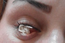 حادثه حیرت انگیز در قوه بینایی بانوی اصلاندوزی/چشمی که نخ تولید می کند+عکس و فیلم