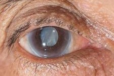 این بیماری خطرناک چشمی را بشناسید